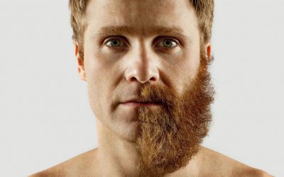 Depilación láser de la barba