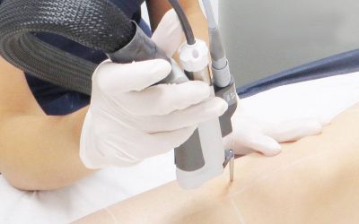 Disparo de prueba antes de la depilación láser