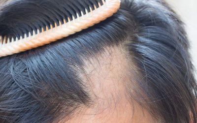 Factores de crecimiento para la calvicie