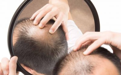 Alopecia Androgenética