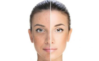 Tratamiento para el melasma
