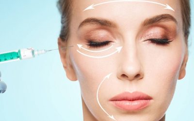 Áreas para los rellenos faciales